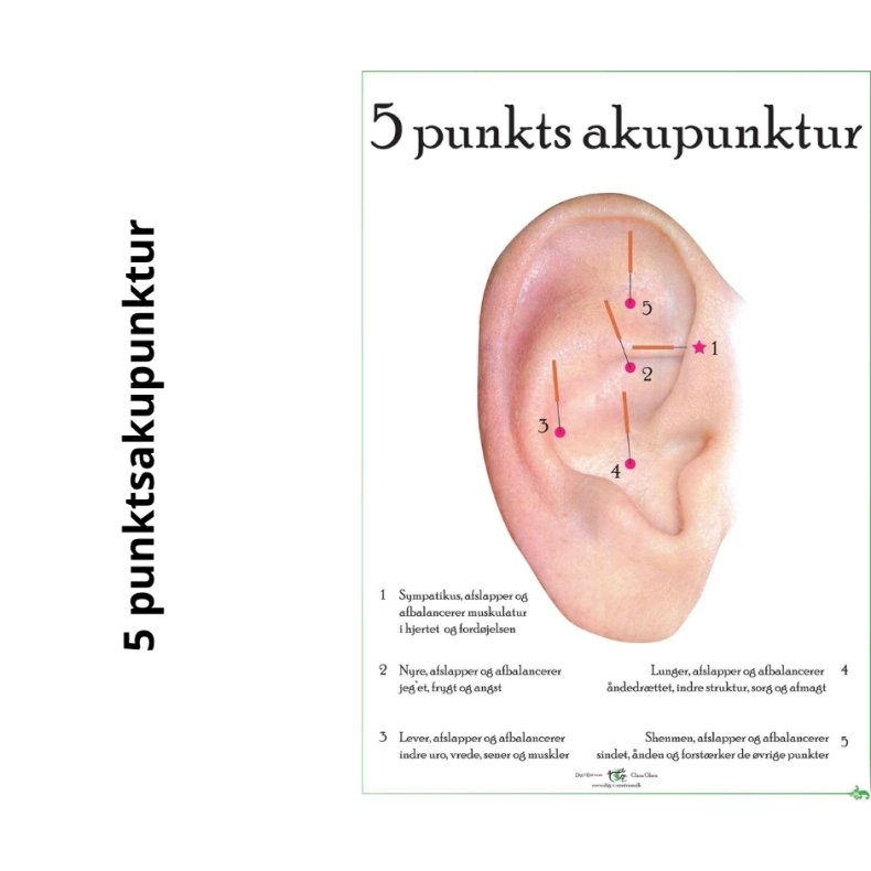 5 Punktsakupunktur i ret