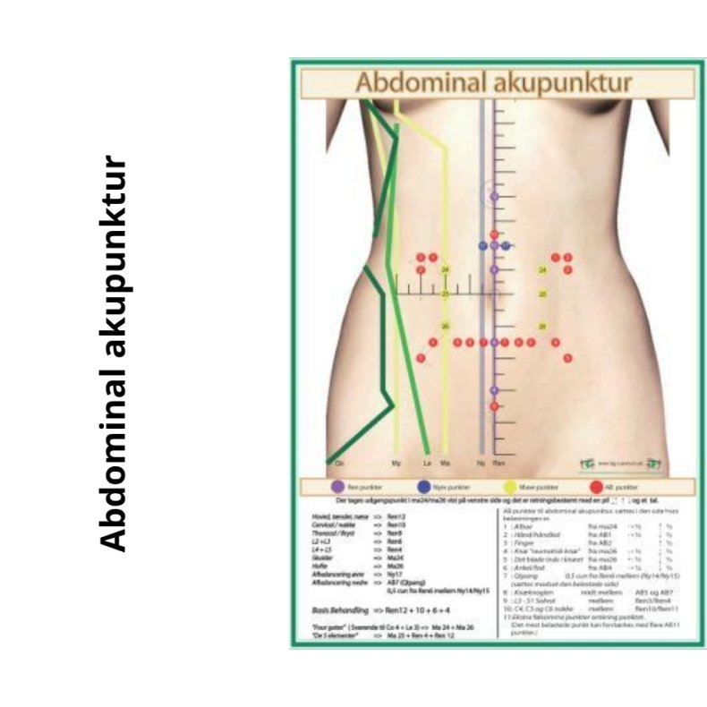 Abdominal akupunktur