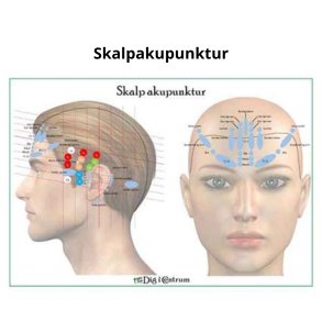Skalpakupunktur
