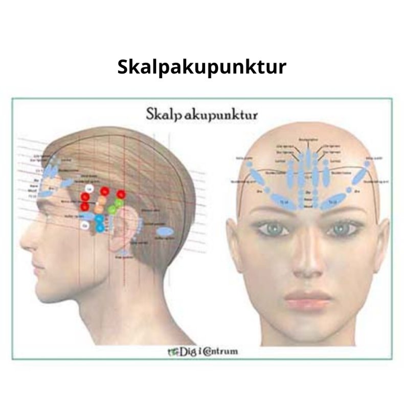 Skalpakupunktur